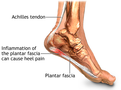 Can Planters Fasciitis Cause Calf Pain