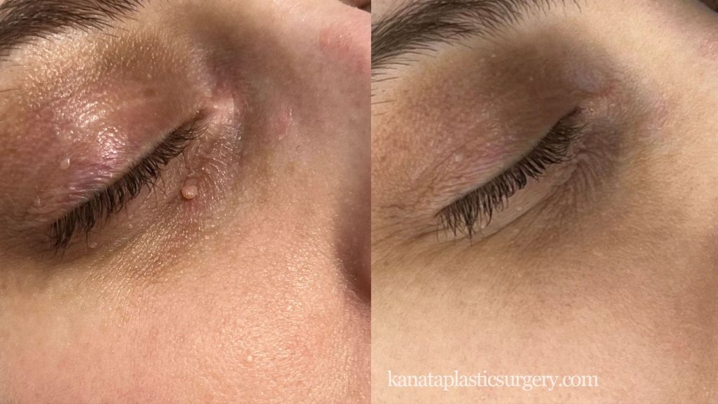 Can You Freeze off Age Spots