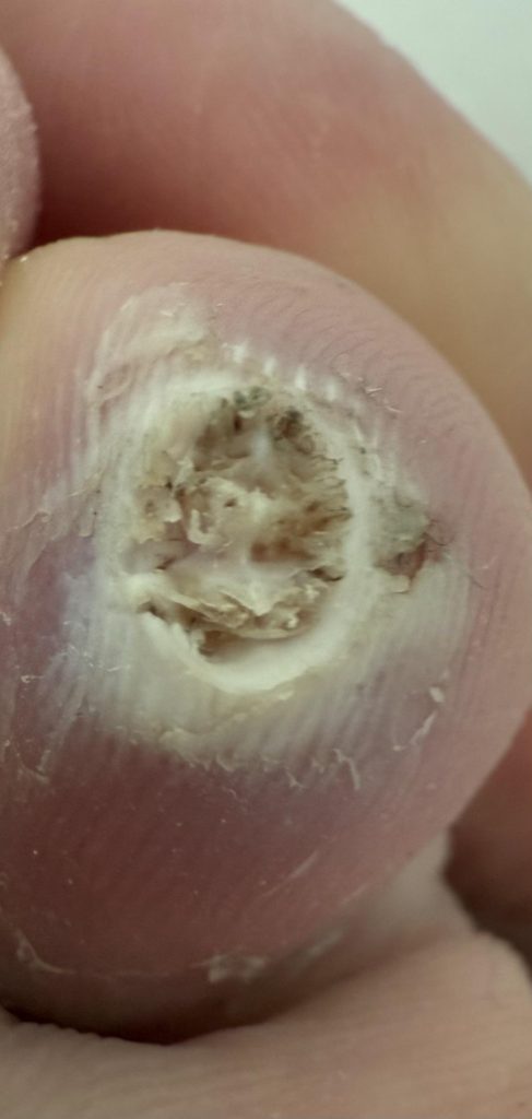 Does Compound W Work on Planters Warts