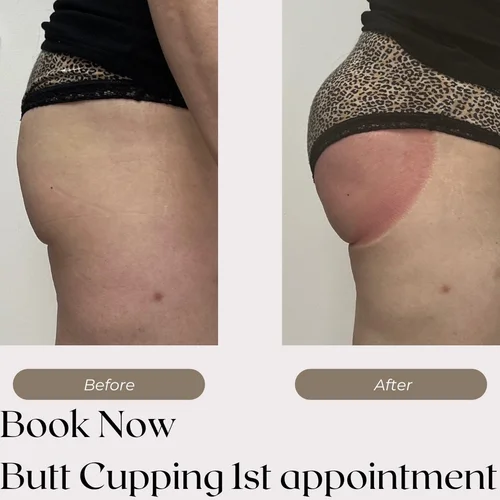 Does Vacuum Butt Lift Work