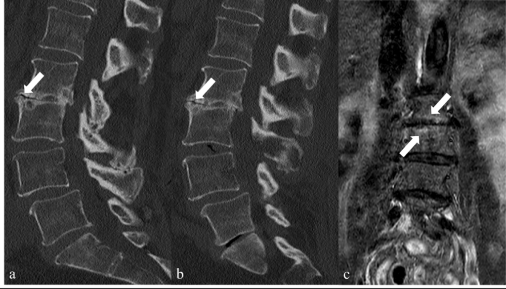 What are the Symptoms of Vacuum Disc Phenomenon