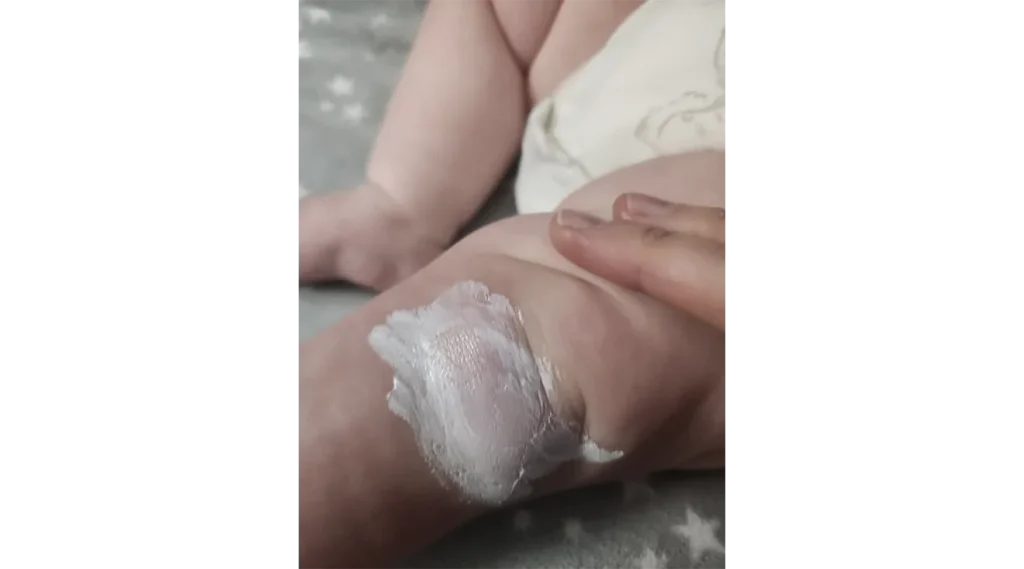 Where to Apply Diaper Rash Cream on Boy