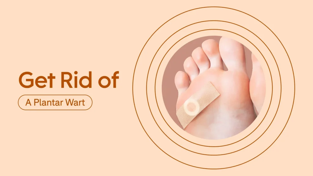 Will a Planters Wart Go Away on Its Own